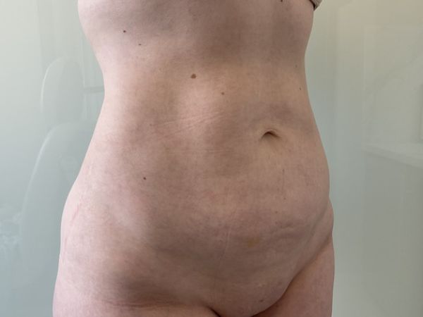 after liposuction right angle view female patient case 4048