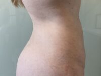 after liposuction right view female patient case 4048