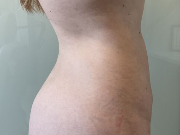 after liposuction right view female patient case 4048