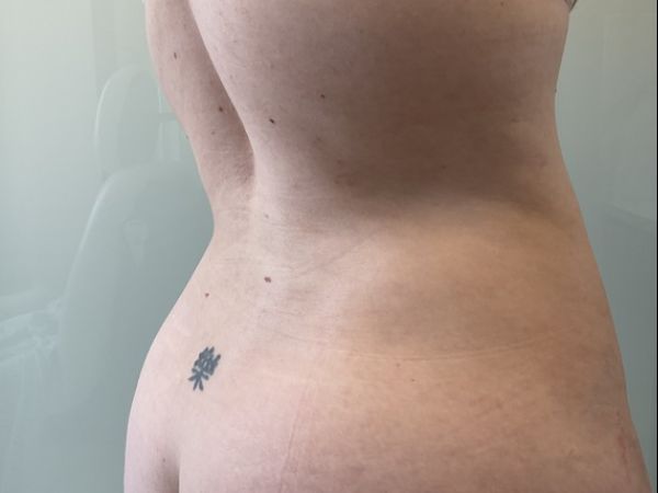 after liposuction right angle view female patient case 4048