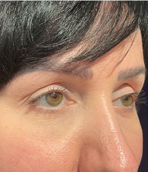 before eyelid surgery right angle view female patient 4161