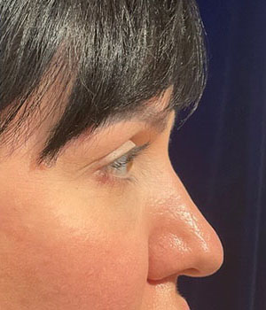 before eyelid surgery right side view female patient 4161