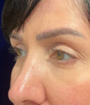before eyelid surgery left angle view female patient 4161
