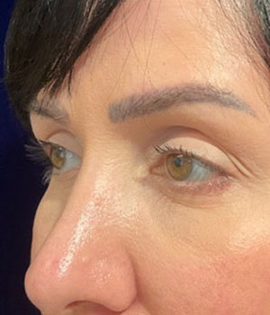 before eyelid surgery left angle view female patient 4161