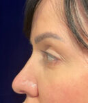 before eyelid surgery left side view female patient 4161