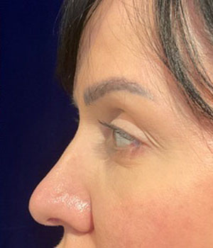 before eyelid surgery left side view female patient 4161