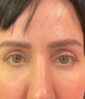 after eyelid surgery front view female patient 4161