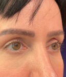 after eyelid surgery right angle view female patient 4161
