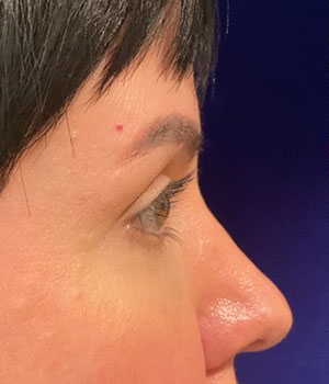 after eyelid surgery right side view female patient 4161