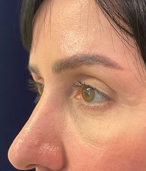after eyelid surgery left angle view female patient 4161