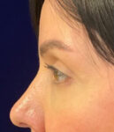after eyelid surgery left side view female patient 4161