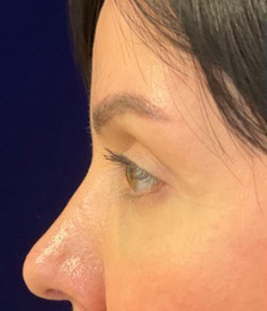 after eyelid surgery left side view female patient 4161