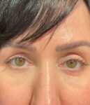 before eyelid surgery front view female patient 4161