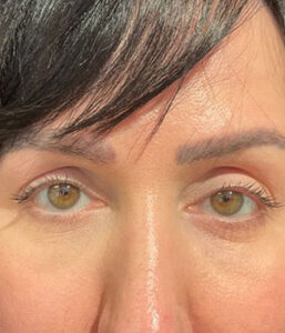 before eyelid surgery front view female patient 4161