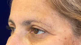 after eyelid surgery left angle view female patient 4150