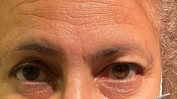 before eyelid surgery front view female patient 4150