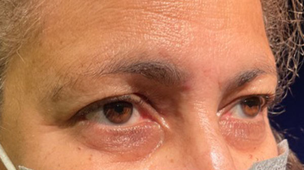 before eyelid surgery right angle view female patient 4150