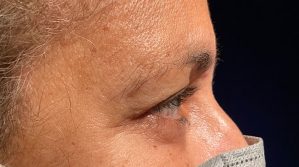 before eyelid surgery right side view female patient 4150