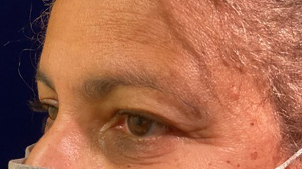 before eyelid surgery left angle view female patient 4150