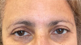 after eyelid surgery front view female patient 4150