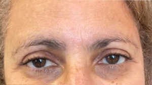 after eyelid surgery front view female patient 4150