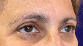 after eyelid surgery right angle view female patient 4150