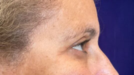 after eyelid surgery right side view female patient 4150