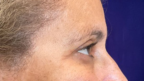 after eyelid surgery right side view female patient 4150