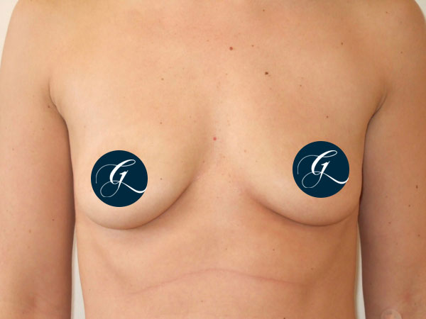 Breast-Aug1
