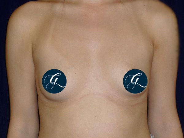 Breast-Aug1a