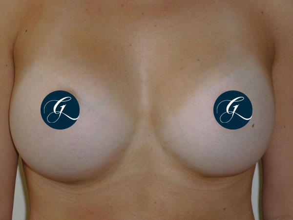 Breast-Aug1b