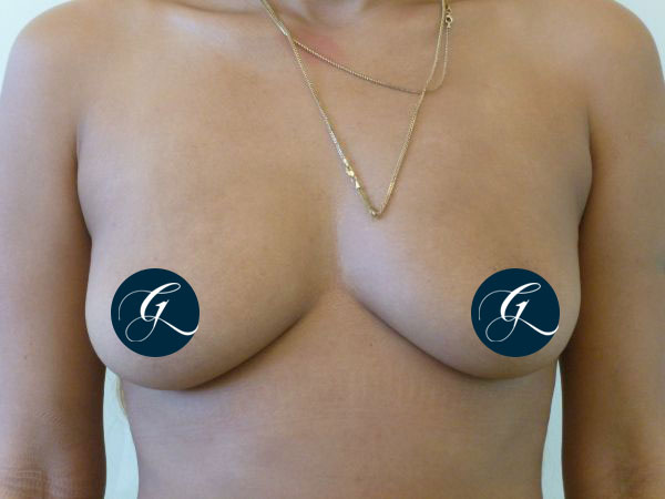 Breast-Aug2a
