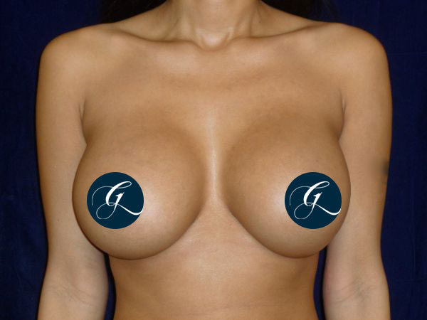 Breast-Aug2b