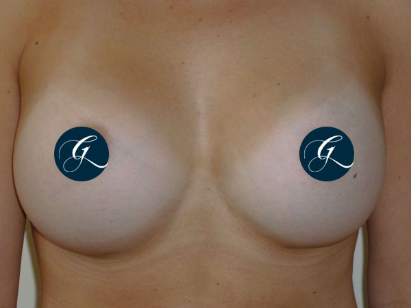 Gray-Banner-breast13