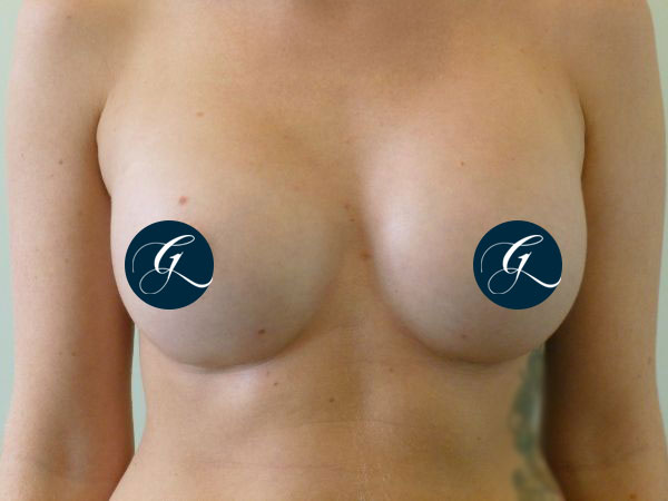 Gray-Banner-breast15