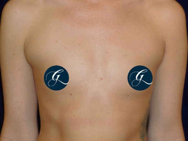 Gray-Banner-breast16