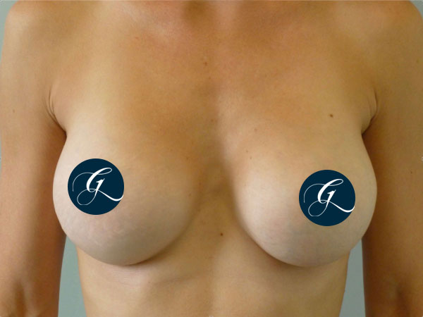 Gray-Banner-breast17