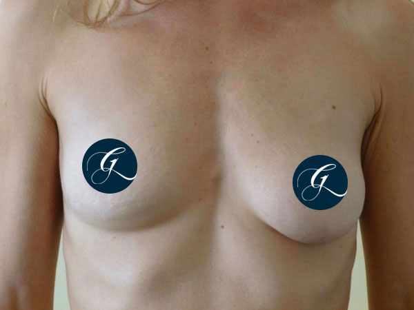 Gray-Banner-breast18
