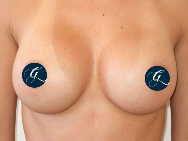 Gray-Banner-breast19