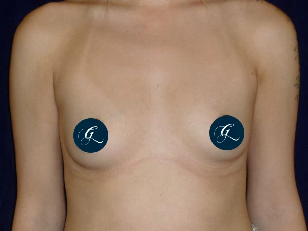 breast-augmentation--3504-covered