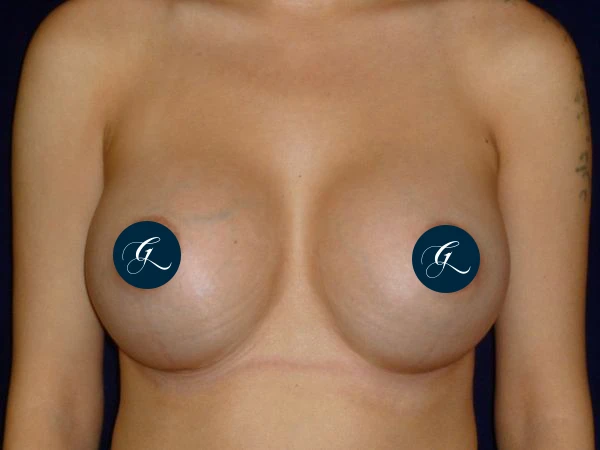 breast-augmentation--3509-covered